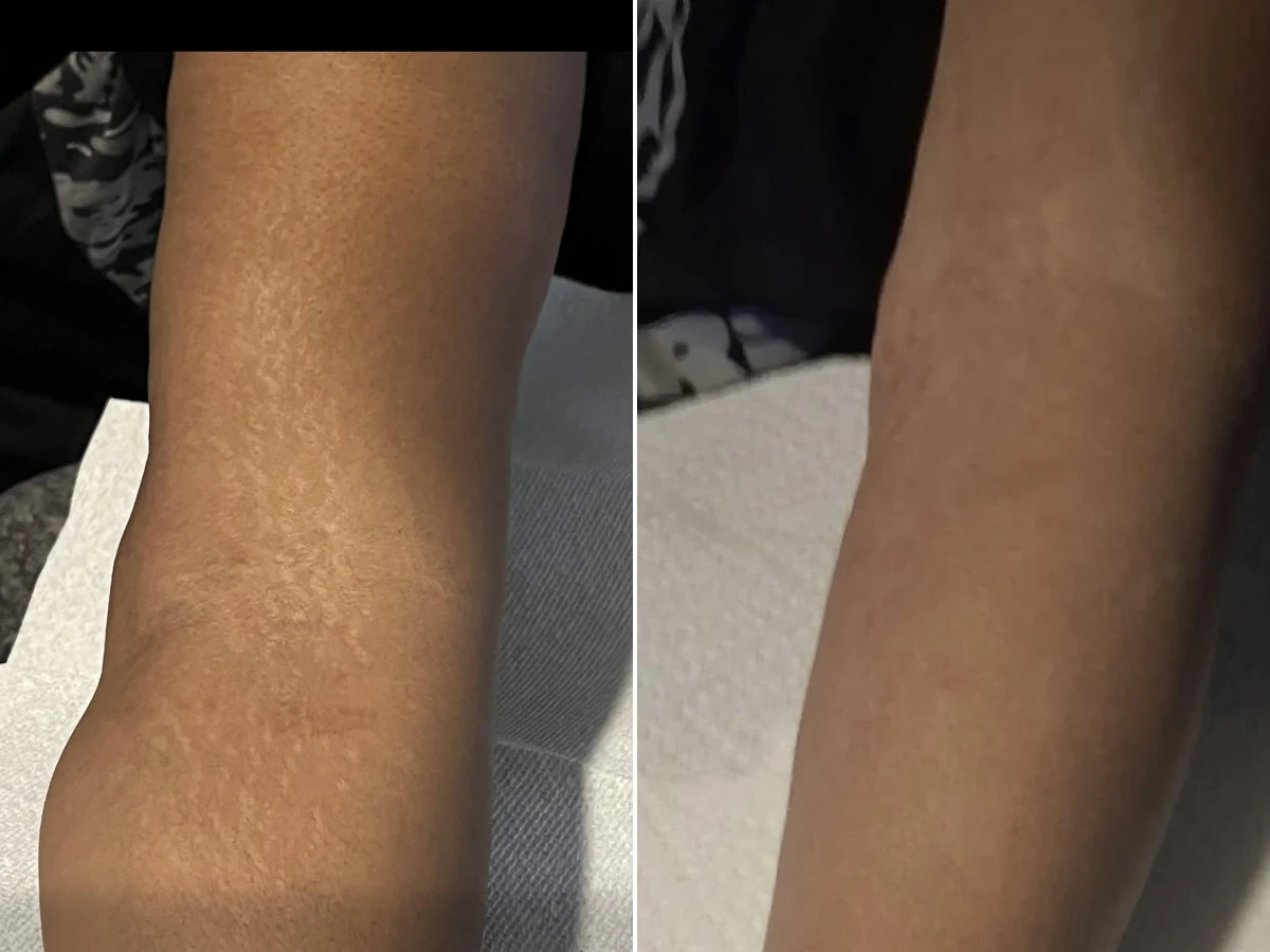 Arm stretch-mark camouflage, before and after example
