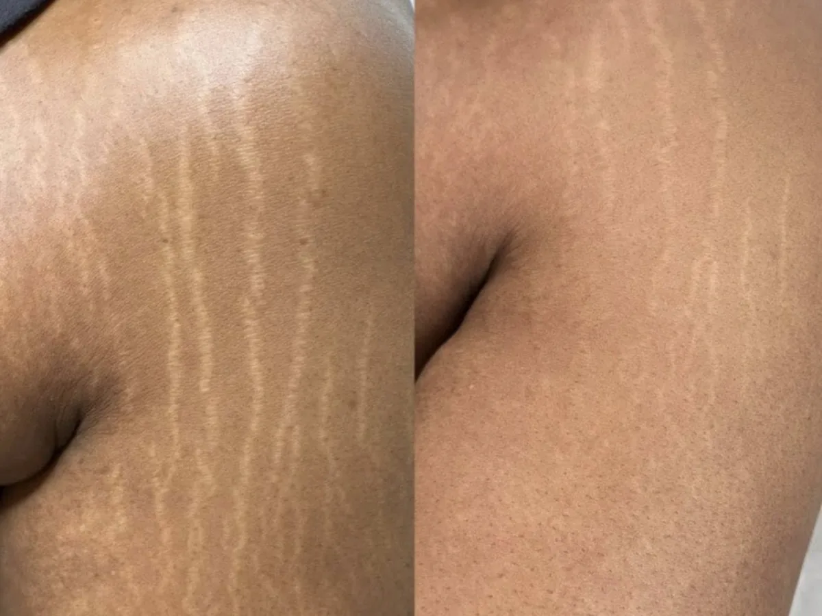 Back stretch-mark camouflage, before and after example