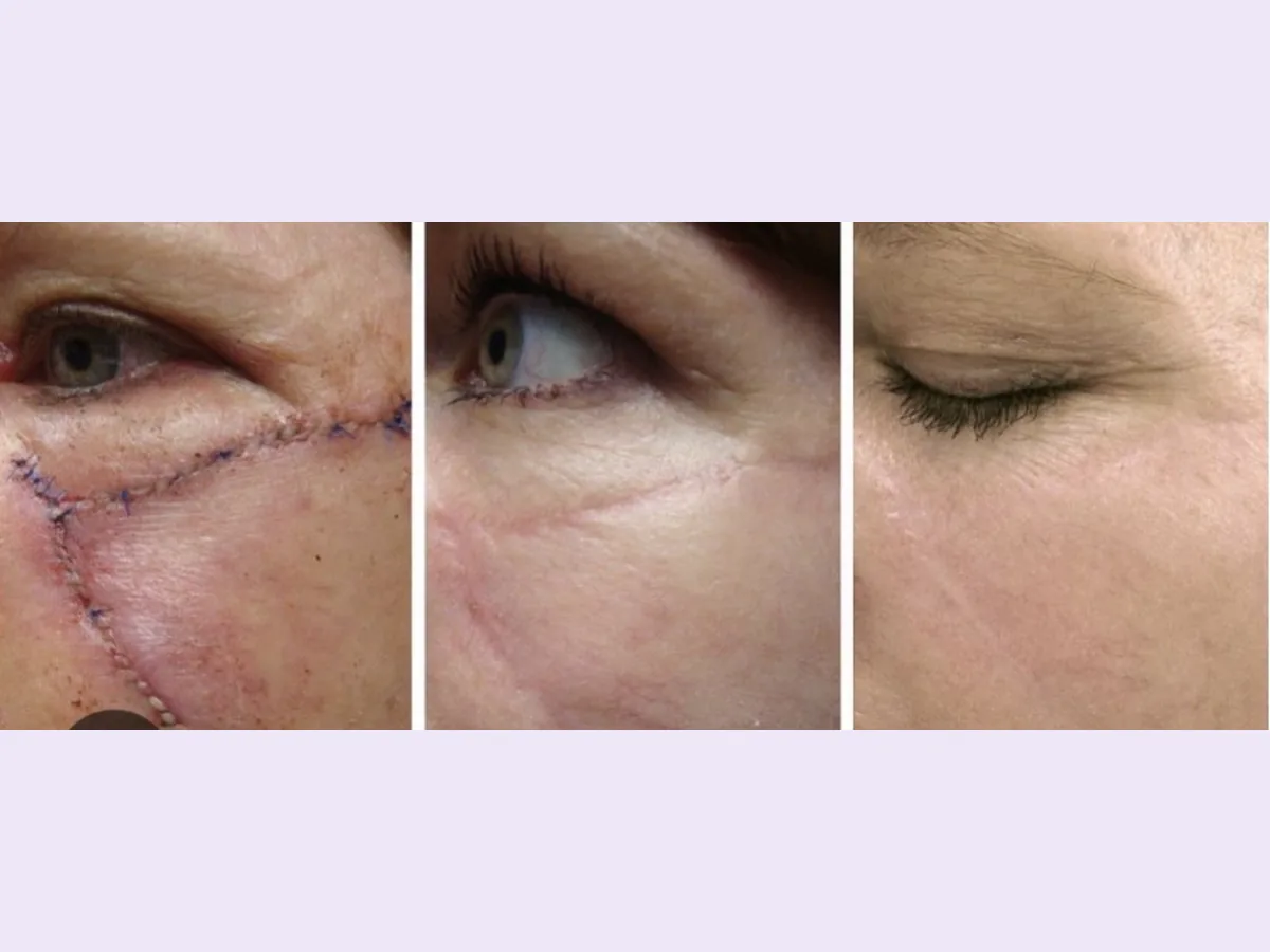 Surgical scar camouflage near the eye, healing progression example
