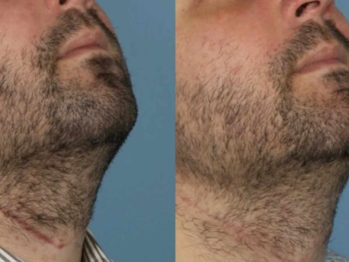 Neck scar camouflage, before and after example